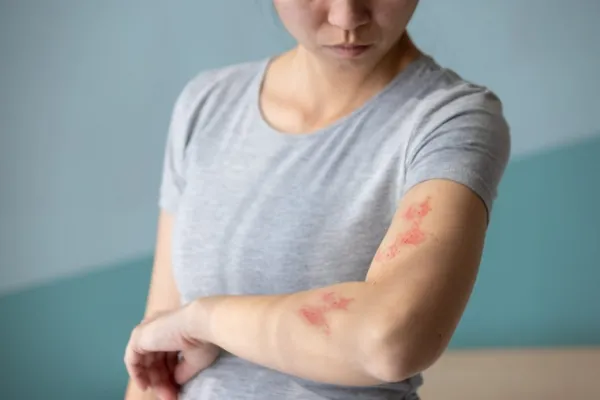 Shingles